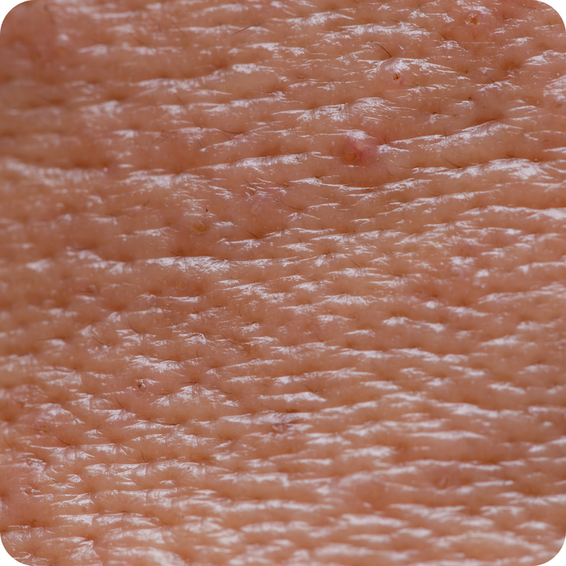 Skincare Routine for Oily Acne Prone Skin